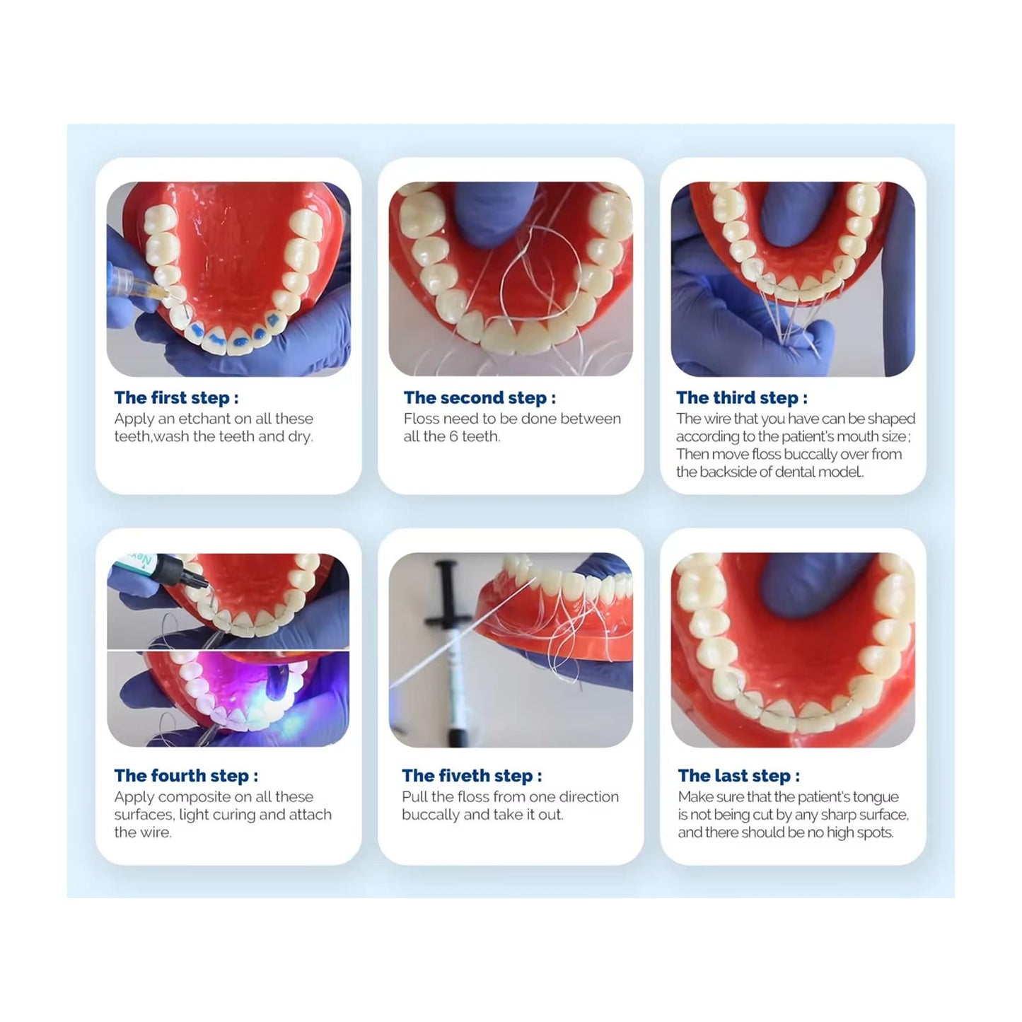 Lingual Fixed Retention